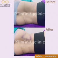 S__131891226.jpg - ดูดไขมัน แผลเล็กมาก เจ็บน้อย ชิวชิว ไม่ต้องวางยา | https://ptinfinity.com