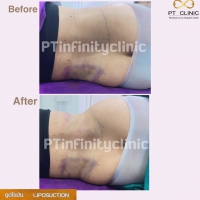 S__131891227.jpg - ดูดไขมัน แผลเล็กมาก เจ็บน้อย ชิวชิว ไม่ต้องวางยา | https://ptinfinity.com