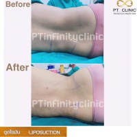 S__131891228.jpg - ดูดไขมัน แผลเล็กมาก เจ็บน้อย ชิวชิว ไม่ต้องวางยา | https://ptinfinity.com