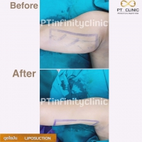 S__131891230.jpg - ดูดไขมัน แผลเล็กมาก เจ็บน้อย ชิวชิว ไม่ต้องวางยา | https://ptinfinity.com