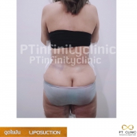 S__131891231.jpg - ดูดไขมัน แผลเล็กมาก เจ็บน้อย ชิวชิว ไม่ต้องวางยา | https://ptinfinity.com