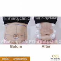 S__131891232.jpg - ดูดไขมัน แผลเล็กมาก เจ็บน้อย ชิวชิว ไม่ต้องวางยา | https://ptinfinity.com