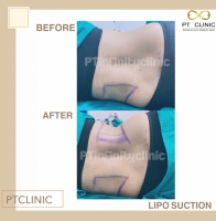 S__131891233.jpg - ดูดไขมัน แผลเล็กมาก เจ็บน้อย ชิวชิว ไม่ต้องวางยา | https://ptinfinity.com