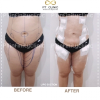 S__131891234.jpg - ดูดไขมัน แผลเล็กมาก เจ็บน้อย ชิวชิว ไม่ต้องวางยา | https://ptinfinity.com