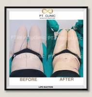 S__131891235.jpg - ดูดไขมัน แผลเล็กมาก เจ็บน้อย ชิวชิว ไม่ต้องวางยา | https://ptinfinity.com