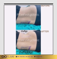 S__131891236.jpg - ดูดไขมัน แผลเล็กมาก เจ็บน้อย ชิวชิว ไม่ต้องวางยา | https://ptinfinity.com