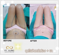 S__131891237.jpg - ดูดไขมัน แผลเล็กมาก เจ็บน้อย ชิวชิว ไม่ต้องวางยา | https://ptinfinity.com