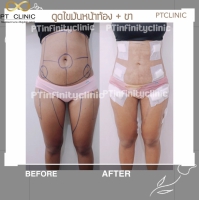 S__131891238.jpg - ดูดไขมัน แผลเล็กมาก เจ็บน้อย ชิวชิว ไม่ต้องวางยา | https://ptinfinity.com