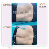 S__131891239.jpg - ดูดไขมัน แผลเล็กมาก เจ็บน้อย ชิวชิว ไม่ต้องวางยา | https://ptinfinity.com