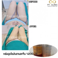 S__131891241.jpg - ดูดไขมัน แผลเล็กมาก เจ็บน้อย ชิวชิว ไม่ต้องวางยา | https://ptinfinity.com