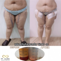 S__131891242.jpg - ดูดไขมัน แผลเล็กมาก เจ็บน้อย ชิวชิว ไม่ต้องวางยา | https://ptinfinity.com