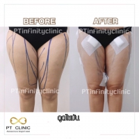 S__131891244.jpg - ดูดไขมัน แผลเล็กมาก เจ็บน้อย ชิวชิว ไม่ต้องวางยา | https://ptinfinity.com