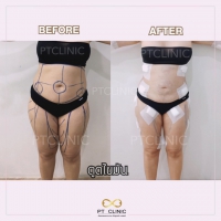 S__131891245.jpg - ดูดไขมัน แผลเล็กมาก เจ็บน้อย ชิวชิว ไม่ต้องวางยา | https://ptinfinity.com