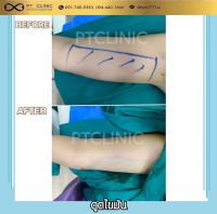 S__131891246.jpg - ดูดไขมัน แผลเล็กมาก เจ็บน้อย ชิวชิว ไม่ต้องวางยา | https://ptinfinity.com