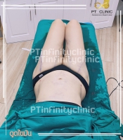 S__131891247.jpg - ดูดไขมัน แผลเล็กมาก เจ็บน้อย ชิวชิว ไม่ต้องวางยา | https://ptinfinity.com