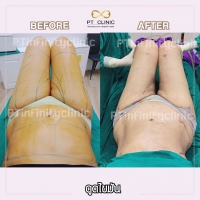 S__131891248.jpg - ดูดไขมัน แผลเล็กมาก เจ็บน้อย ชิวชิว ไม่ต้องวางยา | https://ptinfinity.com