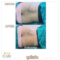 S__131891249.jpg - ดูดไขมัน แผลเล็กมาก เจ็บน้อย ชิวชิว ไม่ต้องวางยา | https://ptinfinity.com