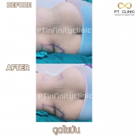 S__131891250.jpg - ดูดไขมัน แผลเล็กมาก เจ็บน้อย ชิวชิว ไม่ต้องวางยา | https://ptinfinity.com