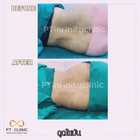 S__131891252.jpg - ดูดไขมัน แผลเล็กมาก เจ็บน้อย ชิวชิว ไม่ต้องวางยา | https://ptinfinity.com