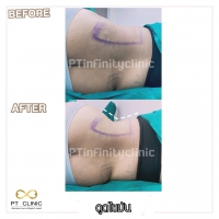 S__131891253.jpg - ดูดไขมัน แผลเล็กมาก เจ็บน้อย ชิวชิว ไม่ต้องวางยา | https://ptinfinity.com