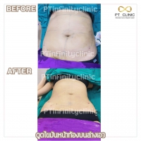 S__131891254.jpg - ดูดไขมัน แผลเล็กมาก เจ็บน้อย ชิวชิว ไม่ต้องวางยา | https://ptinfinity.com