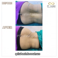 S__131891255.jpg - ดูดไขมัน แผลเล็กมาก เจ็บน้อย ชิวชิว ไม่ต้องวางยา | https://ptinfinity.com