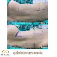 S__131891256.jpg - ดูดไขมัน แผลเล็กมาก เจ็บน้อย ชิวชิว ไม่ต้องวางยา | https://ptinfinity.com