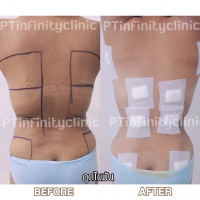S__131891257.jpg - ดูดไขมัน แผลเล็กมาก เจ็บน้อย ชิวชิว ไม่ต้องวางยา | https://ptinfinity.com