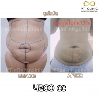 S__131891258.jpg - ดูดไขมัน แผลเล็กมาก เจ็บน้อย ชิวชิว ไม่ต้องวางยา | https://ptinfinity.com