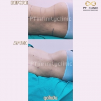 S__131891261.jpg - ดูดไขมัน แผลเล็กมาก เจ็บน้อย ชิวชิว ไม่ต้องวางยา | https://ptinfinity.com