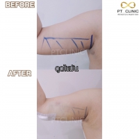 S__131891263.jpg - ดูดไขมัน แผลเล็กมาก เจ็บน้อย ชิวชิว ไม่ต้องวางยา | https://ptinfinity.com