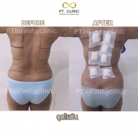 S__131891264.jpg - ดูดไขมัน แผลเล็กมาก เจ็บน้อย ชิวชิว ไม่ต้องวางยา | https://ptinfinity.com