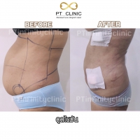 S__131891265.jpg - ดูดไขมัน แผลเล็กมาก เจ็บน้อย ชิวชิว ไม่ต้องวางยา | https://ptinfinity.com