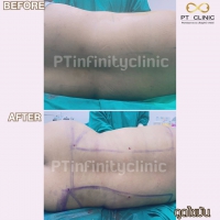 S__131891266.jpg - ดูดไขมัน แผลเล็กมาก เจ็บน้อย ชิวชิว ไม่ต้องวางยา | https://ptinfinity.com