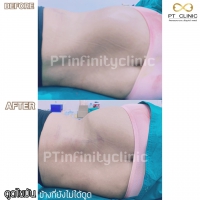 S__131891267.jpg - ดูดไขมัน แผลเล็กมาก เจ็บน้อย ชิวชิว ไม่ต้องวางยา | https://ptinfinity.com