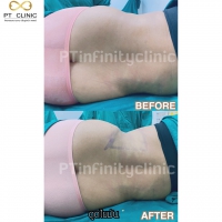 S__131891268.jpg - ดูดไขมัน แผลเล็กมาก เจ็บน้อย ชิวชิว ไม่ต้องวางยา | https://ptinfinity.com