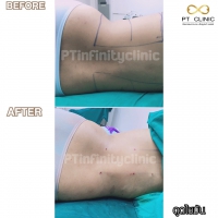 S__131891269.jpg - ดูดไขมัน แผลเล็กมาก เจ็บน้อย ชิวชิว ไม่ต้องวางยา | https://ptinfinity.com