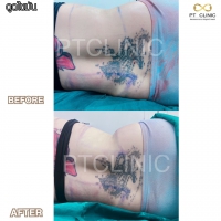 S__131891272.jpg - ดูดไขมัน แผลเล็กมาก เจ็บน้อย ชิวชิว ไม่ต้องวางยา | https://ptinfinity.com