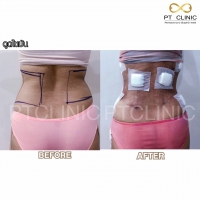 S__131891274.jpg - ดูดไขมัน แผลเล็กมาก เจ็บน้อย ชิวชิว ไม่ต้องวางยา | https://ptinfinity.com