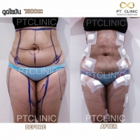 S__131891275.jpg - ดูดไขมัน แผลเล็กมาก เจ็บน้อย ชิวชิว ไม่ต้องวางยา | https://ptinfinity.com