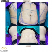 S__131891276.jpg - ดูดไขมัน แผลเล็กมาก เจ็บน้อย ชิวชิว ไม่ต้องวางยา | https://ptinfinity.com