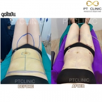 S__131891277.jpg - ดูดไขมัน แผลเล็กมาก เจ็บน้อย ชิวชิว ไม่ต้องวางยา | https://ptinfinity.com