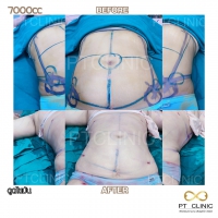 S__131891278.jpg - ดูดไขมัน แผลเล็กมาก เจ็บน้อย ชิวชิว ไม่ต้องวางยา | https://ptinfinity.com