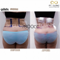 S__131891279.jpg - ดูดไขมัน แผลเล็กมาก เจ็บน้อย ชิวชิว ไม่ต้องวางยา | https://ptinfinity.com