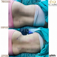 S__131891280.jpg - ดูดไขมัน แผลเล็กมาก เจ็บน้อย ชิวชิว ไม่ต้องวางยา | https://ptinfinity.com