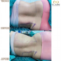 S__131891281.jpg - ดูดไขมัน แผลเล็กมาก เจ็บน้อย ชิวชิว ไม่ต้องวางยา | https://ptinfinity.com