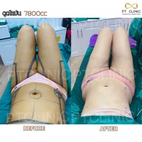 S__131891283.jpg - ดูดไขมัน แผลเล็กมาก เจ็บน้อย ชิวชิว ไม่ต้องวางยา | https://ptinfinity.com