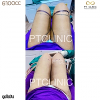 S__131891285.jpg - ดูดไขมัน แผลเล็กมาก เจ็บน้อย ชิวชิว ไม่ต้องวางยา | https://ptinfinity.com