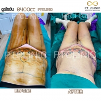 S__131891288.jpg - ดูดไขมัน แผลเล็กมาก เจ็บน้อย ชิวชิว ไม่ต้องวางยา | https://ptinfinity.com