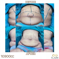 S__131891289.jpg - ดูดไขมัน แผลเล็กมาก เจ็บน้อย ชิวชิว ไม่ต้องวางยา | https://ptinfinity.com